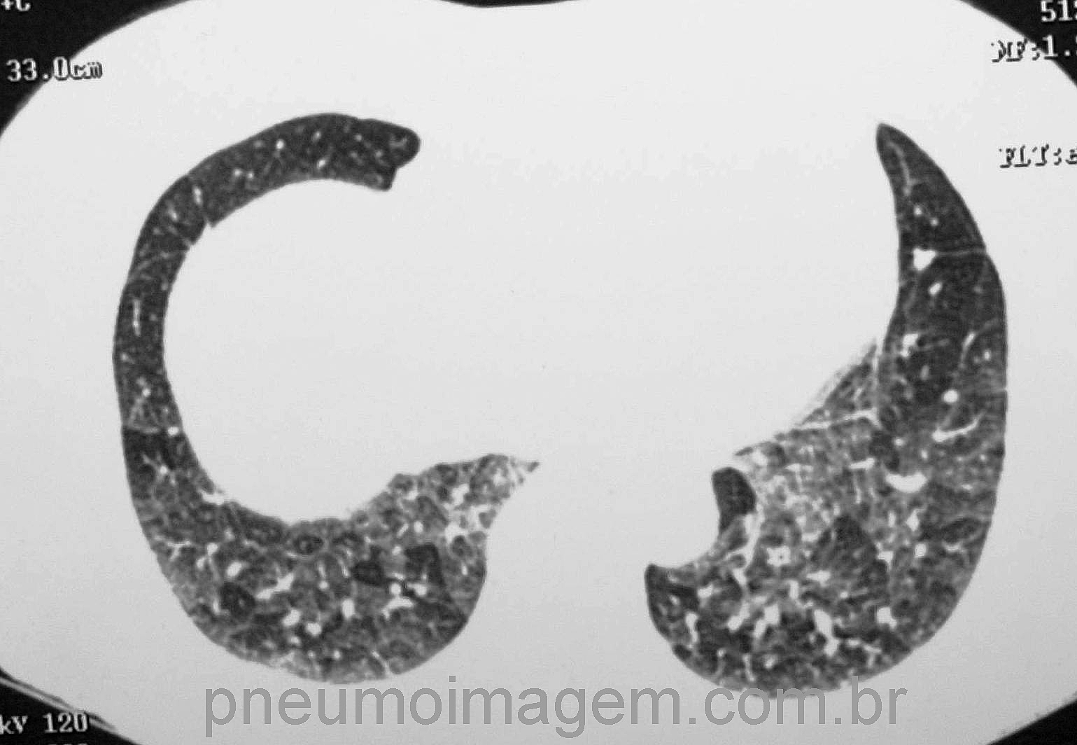 DESTAQUES DO ERS2016: VITAMINA D PODE REDUZIR AS CRISES DE ASMA